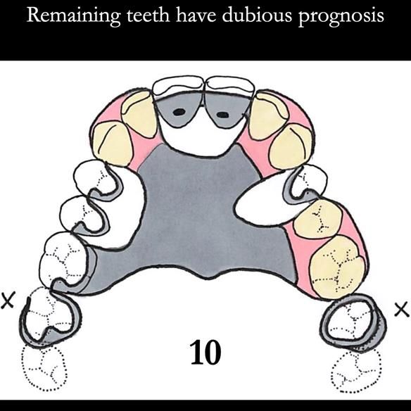 Universal Scandinavian partial denture designs