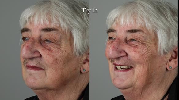 Newsletter 55 Provision of metal based partial dentures for Zephyrine with a repaired cleft lip and palate