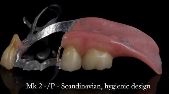 Newsletter 54 case presentation upper complete denture and lower Scandinavian designed hygienic partial denture for David