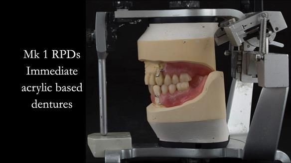Finlay's Case Study Newsletter 40 - Immediate Mk 1 RPD to Definitive Mk 2 RPD - full protocol