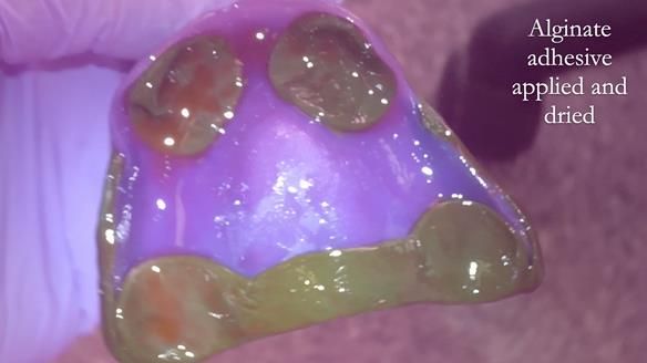 Finlay's Newsletter 62 provision of extractions and metal based complete dentures for Rafique