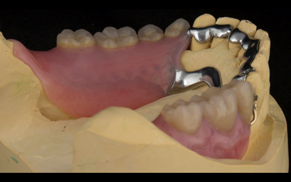 Figure 111 Mk 2 mandibular metal based denture showing open Scandinavian hygienic design.