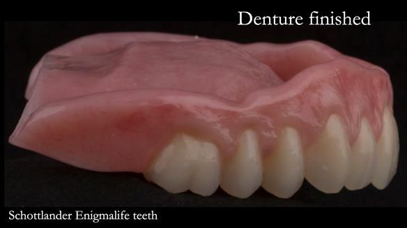 Newsletter 75: Marion’s case - Step-by-step complete denture workflow