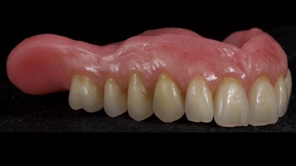 Newsletter 80 - Gordon’s dentures: the one case in 1,000 where my technique failed