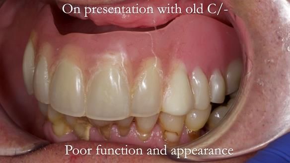 Newsletter 54 case presentation upper complete denture and lower Scandinavian designed hygienic partial denture for David
