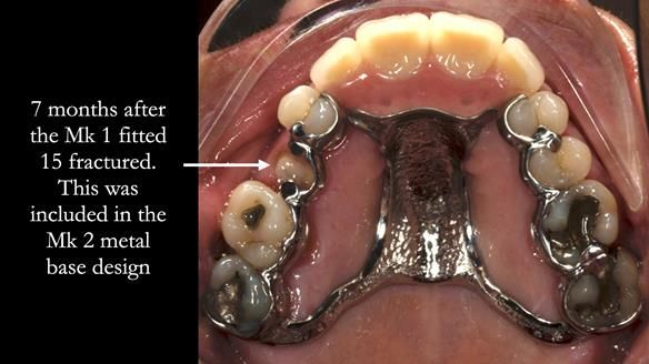 Finlay's Newsletter 63 Case study provision of metal based Scandinavian RPD - functional 10 years on