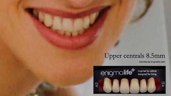Upper central incisors of 8.5mm wide - Schottlander Enigmalife teeth. To match the same shape as her daughters teeth.