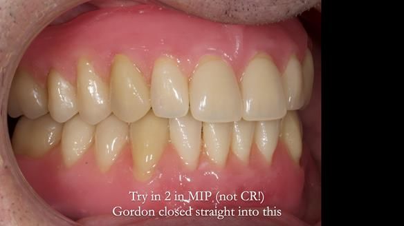 Newsletter 80 - Gordon’s dentures: the one case in 1,000 where my technique failed