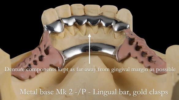 Newsletter 52 Managing Jo’s failing dentition with extractions and Mk 1/Mk 2 complete upper dentures and lower partial dentures FULL PROTOCOL