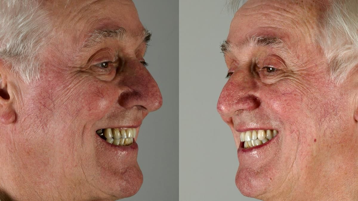 Newsletter 89 – Simon: A Challenging Kennedy Class II Division 1 Upper CoCr Partial Denture with a High Smile Line