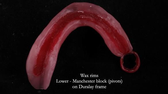 Finlay's Newsletter 59 Ultra hard partial dentures made for Gill