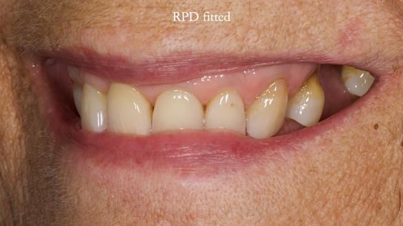 Finlay's Newsletter 61 provision of a lower unilateral free end saddle metal based partial denture for Joyce