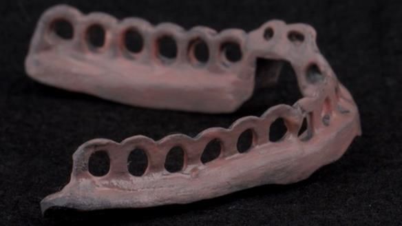 Managing poor implant positioning with complete dentures and Locator attachments - full protocol Newsletter 41