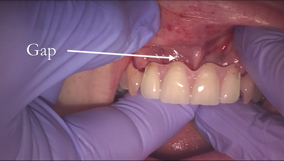 Figure 35 More alveolar tissue lost following extraction than anticipated. This space was filled in with Visco-gel as in the following slides