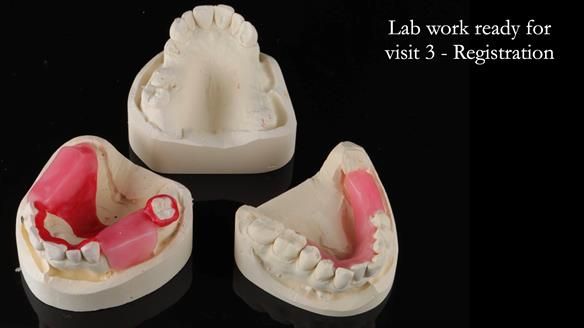 Finlay's Newsletter 60 Sylvia's upper Kennedy Class 2 Mod 1 metal based upper RPD