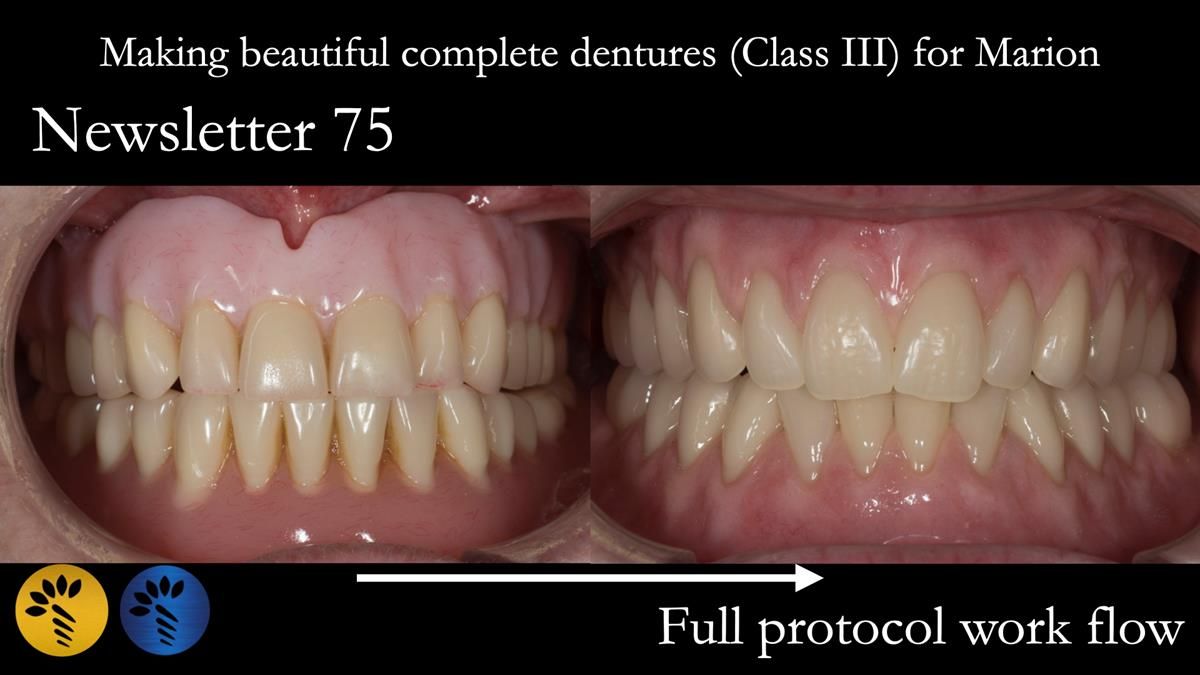 Newsletter 75: Marion’s case - Step-by-step complete denture workflow