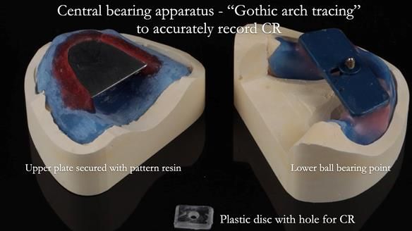 Finlay's Newsletter 62 provision of extractions and metal based complete dentures for Rafique