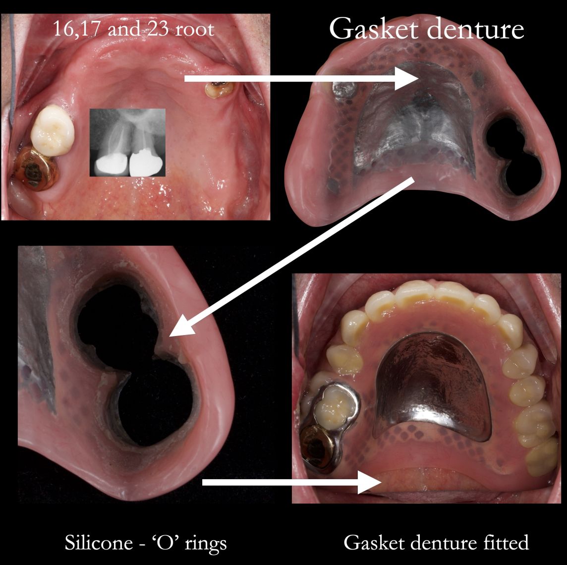 The 'Gasket' denture