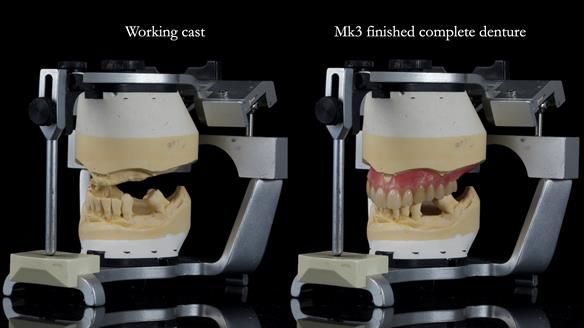 Newsletter 77: Jeremy’s case – immediate complete upper denture