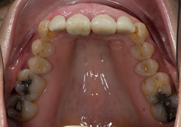Figure 9 upper arch crowns on upper anterior teeth preoperatively
