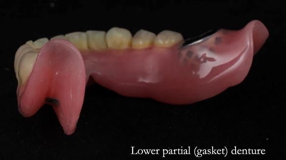 Newsletter 82 Mary - A complete upper and a one-tooth gasket denture