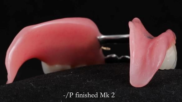 Newsletter 52 Managing Jo’s failing dentition with extractions and Mk 1/Mk 2 complete upper dentures and lower partial dentures FULL PROTOCOL
