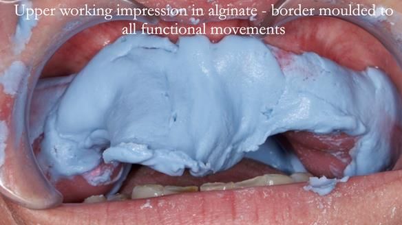 Newsletter 52 Managing Jo’s failing dentition with extractions and Mk 1/Mk 2 complete upper dentures and lower partial dentures FULL PROTOCOL