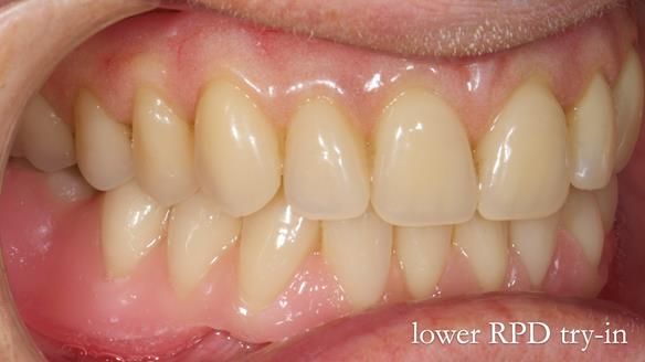 Newsletter 82 Mary - A complete upper and a one-tooth gasket denture