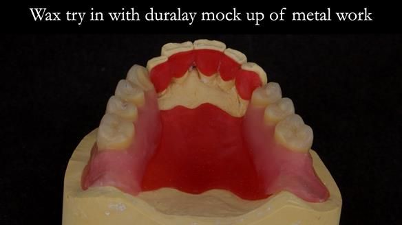 Finlay's Case Study Newsletter 40 - Immediate Mk 1 RPD to Definitive Mk 2 RPD - full protocol