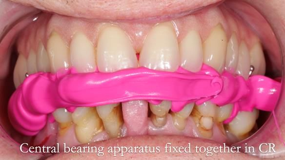Newsletter 54 case presentation upper complete denture and lower Scandinavian designed hygienic partial denture for David