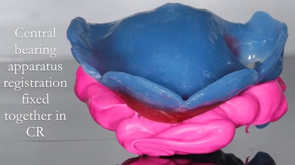 Finlay's Newsletter 58 Gasket upper partial denture for Zoe