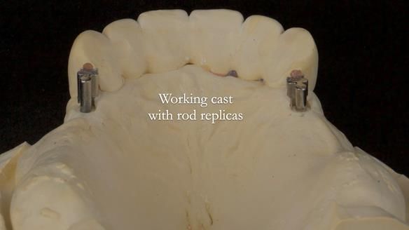 Newsletter 76: Jackie’s case – Telescopic overdenture & precision RPD (the tricky truth!)