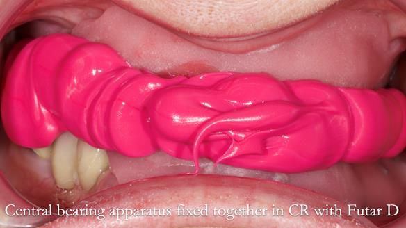 Newsletter 82 Mary - A complete upper and a one-tooth gasket denture