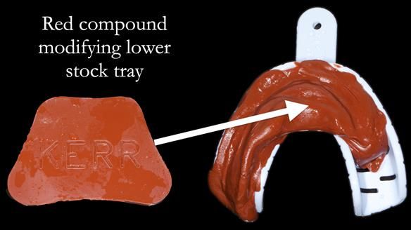 Finlay's Newsletter 59 Ultra hard partial dentures made for Gill