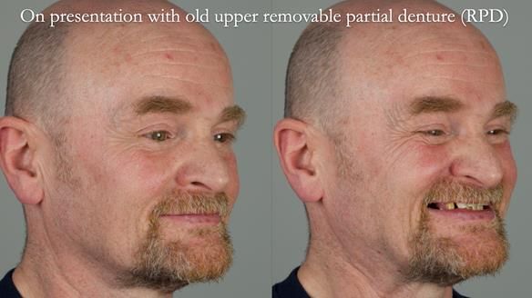 How Keith’s combat denture transformed his life – Newsletter 73