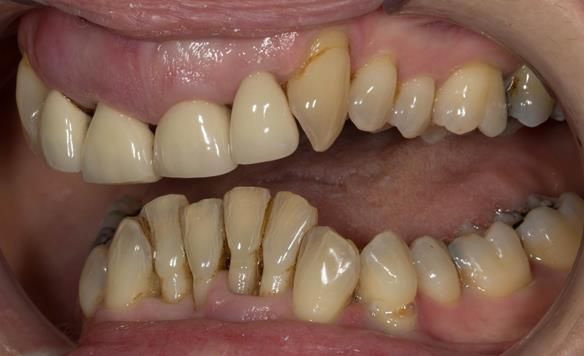 Figure 6 Overeruption of the upper and lower anterior segments with traumatic overbite and aesthetic failure