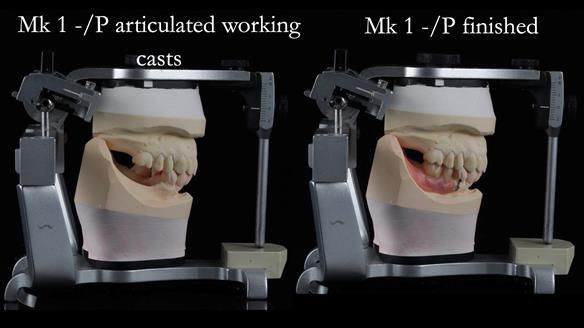 Newsletter 54 case presentation upper complete denture and lower Scandinavian designed hygienic partial denture for David