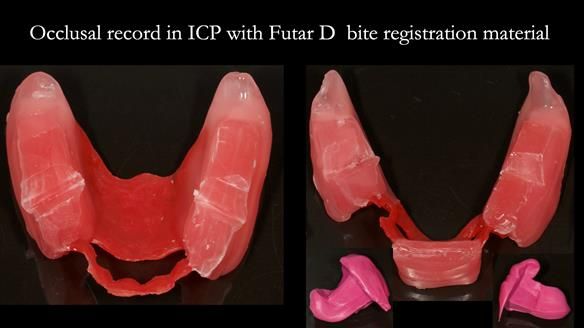 Finlay's Case Study Newsletter 40 - Immediate Mk 1 RPD to Definitive Mk 2 RPD - full protocol