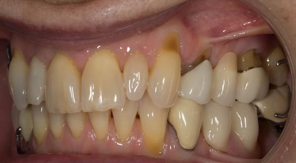 Figure 38 Immediate dentures fitting in ICP. Schottlander Enigmalife teeth.