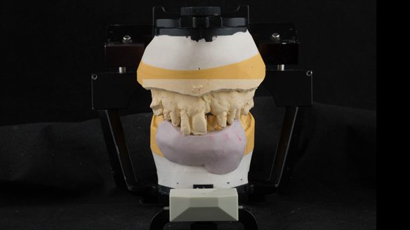 Figure 24 Mounted casts for Mk 1 denture. Silicone index used as a guide for positioning denture teeth