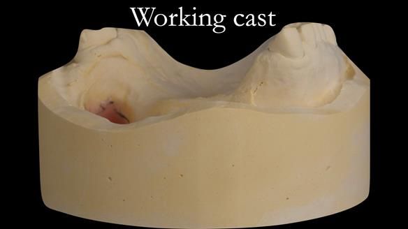 Upper metal base partial denture/occlusal stabilisation splint/obturator - full protocol