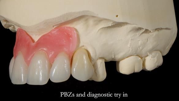 Newsletter 81 - Pam’s Story — how a partial denture changed her life (+ live walkthrough this Thursday)