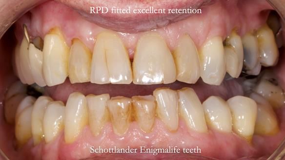 Finlay's Newsletter 64 case study - provision of a Kennedy class 2 metal based Scandinavian RPD for Ian