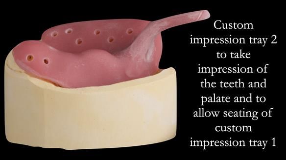 Upper metal base partial denture/occlusal stabilisation splint/obturator - full protocol