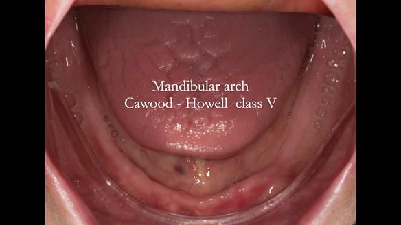 Newsletter 75: Marion’s case - Step-by-step complete denture workflow