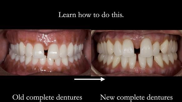 Finlay's Newsletter 59 Ultra hard partial dentures made for Gill