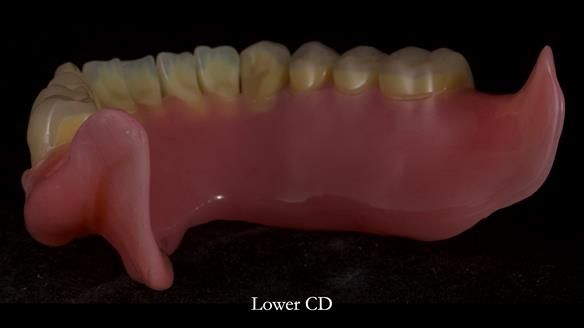 Newsletter 83: Sheila’s Complete Denture Success