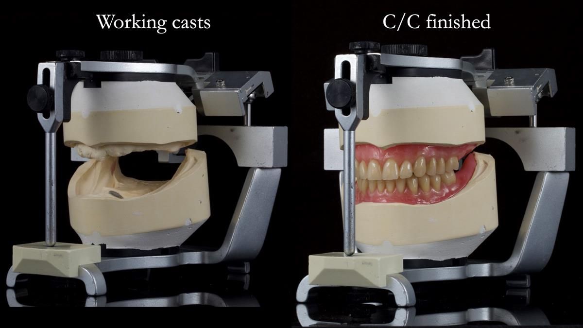 Fin’s Newsletter 88 — Complete dentures - full protocol… he rearranged his own teeth!
