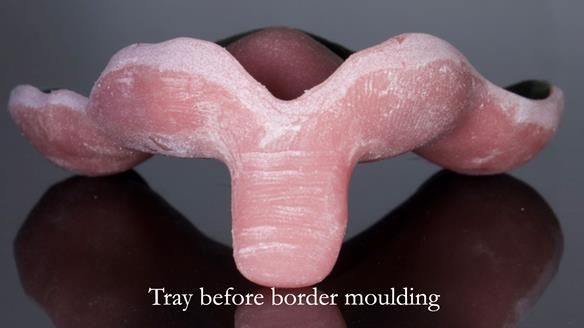 Newsletter 54 case presentation upper complete denture and lower Scandinavian designed hygienic partial denture for David