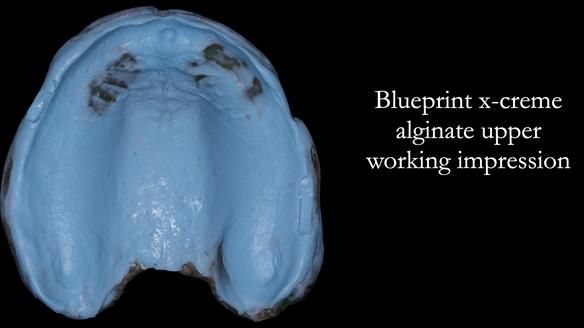 Newsletter 53 showing the making and fitting of ultra life-like dentures for Valena